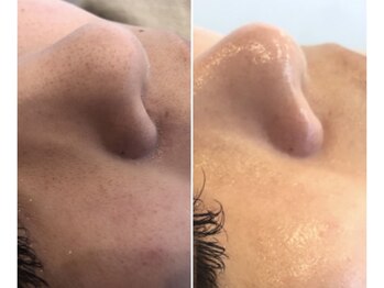 リバース 大波止店/水素洗浄 ハイドロ 毛穴ケア