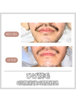エクレ 今池店(EKURE)/ヒゲ脱毛