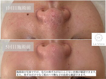 ラヴィオーラ 姫路店(La Viora)/ダイヤモンドハーブピーリング