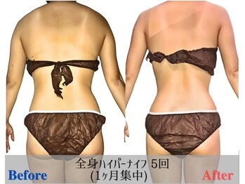 マリス(MARISS)/1ヶ月集中【ハイパ-ナイフ痩身】