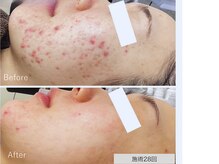 ニキビ研究所 千葉店/赤ニキビ・白ニキビケアも同時に