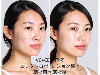 憩いサロンユリ 蕨店(Yuri)/エレクトロポーレション導入