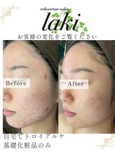 リラクゼーションサロン ラキ(laki)/トロイアルケ　スキンメイド