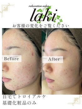 リラクゼーションサロン ラキ(laki)/トロイアルケ　スキンメイド