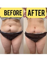 トータルビューティーアンドウィズ(total beauty&WITH)/脂肪冷却