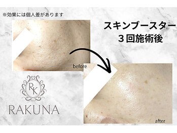 ラクナ(RAKUNA)/水光白玉肌/素肌ケア/肌エステ