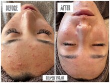 ハオン(HAON)/ハーブピーリング/ニキビ/毛穴