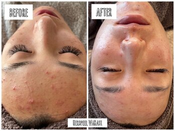 ハオン(HAON)/ハーブピーリング/ニキビ/毛穴