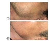 エース 赤坂/髭脱毛の症例写真
