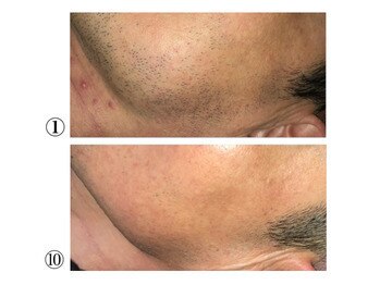 エース 赤坂/髭脱毛の症例写真