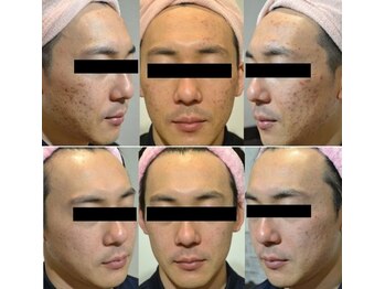 GRACETHOUSAND(グレイスサウザンド)/ハーブピーリング/ニキビケア