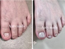 アーティネイルズ(Aaty Nails)/フット深爪矯正