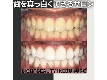 ライトビューティー 池袋店(LightBeauty)/症例写真