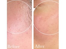 MMK/つるりん肌で毛穴レスモテ肌へ