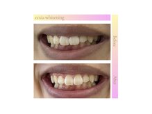エクシアホワイトニング エミフルMASAKI店/ホワイトニングビフォーアフター