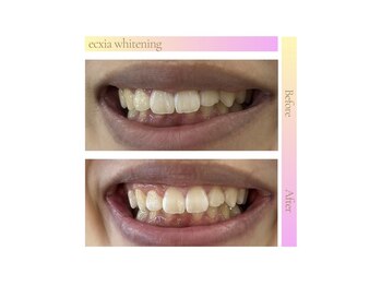 エクシアホワイトニング エミフルMASAKI店/ホワイトニングビフォーアフター