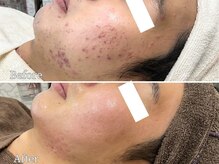 ニキビケア研究所 本厚木店/ほほニキビケア