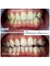 ホワイトニングサロン 京都烏丸店/ホワイトニング施術例