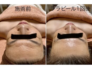 サララ(SaLaLa)/ララピール効果