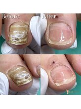 巻き爪補正店 越谷店/変形爪補正