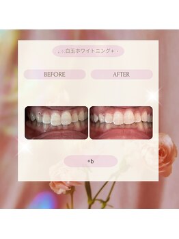 プラスビー 2号店(+b)/ホワイトニングビフォーアフター