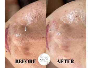 グロウ(GLOW)/毛穴の黒ずみ・毛穴でお悩みの方