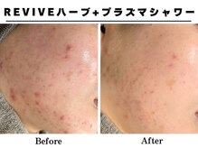 リッチ(Rich+)の雰囲気（ハーブピーリングとプラズマシャワーのセット3回での効果です◎）