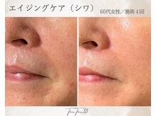 スリースリー 恵比寿(THREE THREE)/エイジングケア・しわ・たるみ