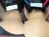 この夏必須！薄着対策に♪うなじ2回＋背中＆うなじ美肌パックSET￥4,900