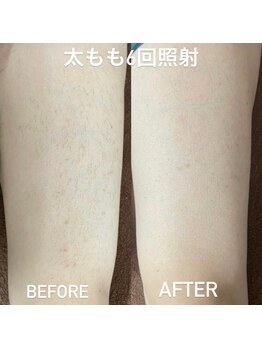 ココ(Coco)/足脱毛６回：ビフォーアフター