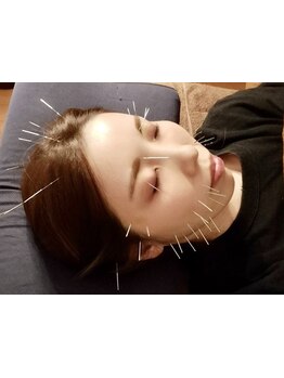 鍼灸施術を受けたい