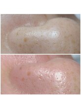 ウォーマル(warmaL)/フェイシャルワックス脱毛