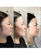 アーフ(ARF)/エクソリフト