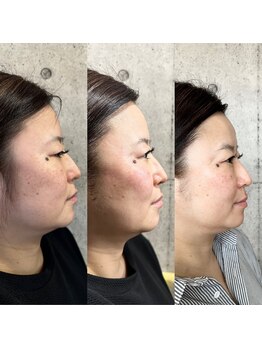 アーフ(ARF)/エクソリフト