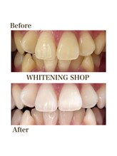 ホワイトニングショップ 泉佐野店/フリーパスコースbefore after