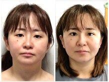 美容整体ウェリナ 中川八田院/.【小顔矯正before→after】