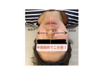 ニコリ(Nicori)/光フェイシャル