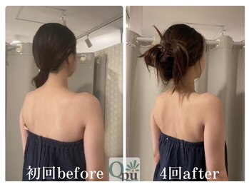 キュープ 福岡天神店(Qpu)/巻肩矯正4回での変化
