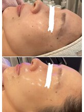 マーガレット(Marguerite)/ILLONスキンジェクションプロ