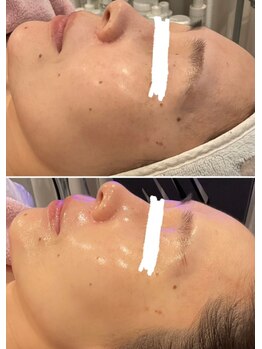 マーガレット(Marguerite)/ILLONスキンジェクションプロ