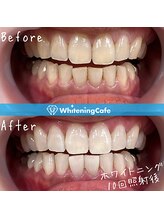 ホワイトニングカフェ 綾瀬店(WhiteningCafe)/◎歯のホワイトニング施術写真◎