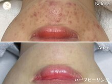 プリュボーテ 吉祥寺(Pul Beaute)の雰囲気（ハーブピーリングで毛穴や肌荒れを撃退！滑らかなお肌へ導きます）
