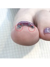 ヴォーグ(Vogue)/いたくない巻き爪緩和