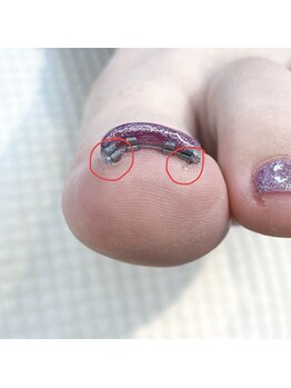 ヴォーグ(Vogue)/いたくない巻き爪緩和