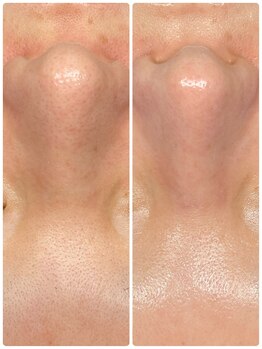 ダリア(DAHLIA)/ハイドラフェイシャル・5