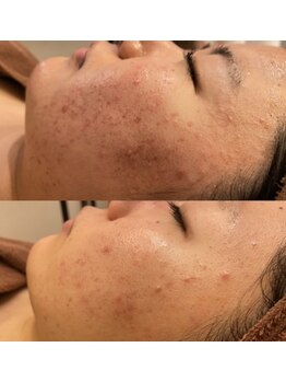 リライズ 磐田(Rerise)/ハーブピーリング