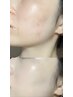 ブラジリアンワックス顔脱毛+保湿パック付/毛穴洗浄/産毛/クスミ¥6800