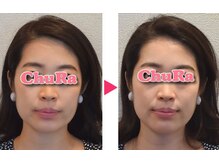 チュラ鍼灸院 西宮北口(ChuRa鍼灸院)/経絡リンパマッサージ&美容鍼