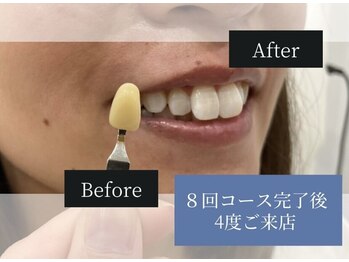 ホワイトニングカフェ 白山店(WhiteningCafe)/◎歯のホワイトニング施術写真◎