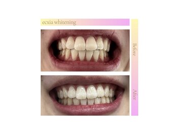 エクシアホワイトニング エミフルMASAKI店/ホワイトニングビフォーアフター